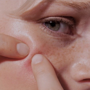 OIL CONTROL AND ACNE